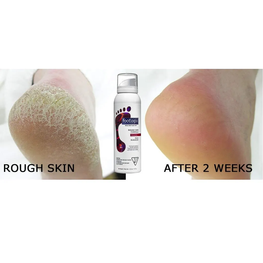 FOOT LOGIC Rough Skin Formula